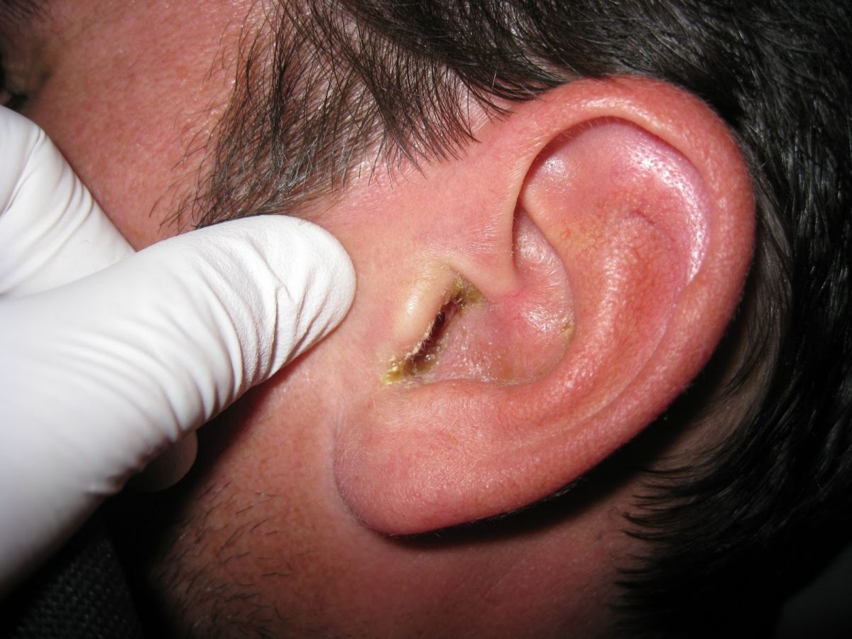 Otitis-externa-1200x900.jpg